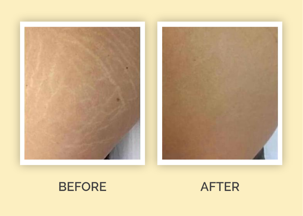 Stretch Mark Removal